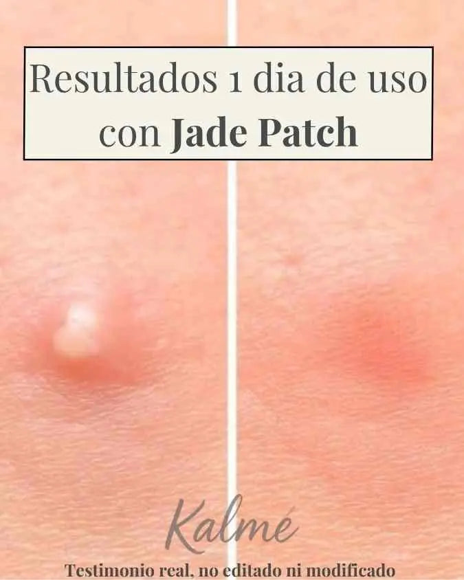 Jade Patch - Elimina todo tipo de espinillas y granos en menos de 24 horas (1+1 GRÁTIS)