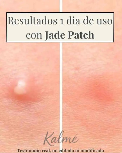 Jade Patch - Elimina todo tipo de espinillas y granos en menos de 24 horas (1+1 GRÁTIS)